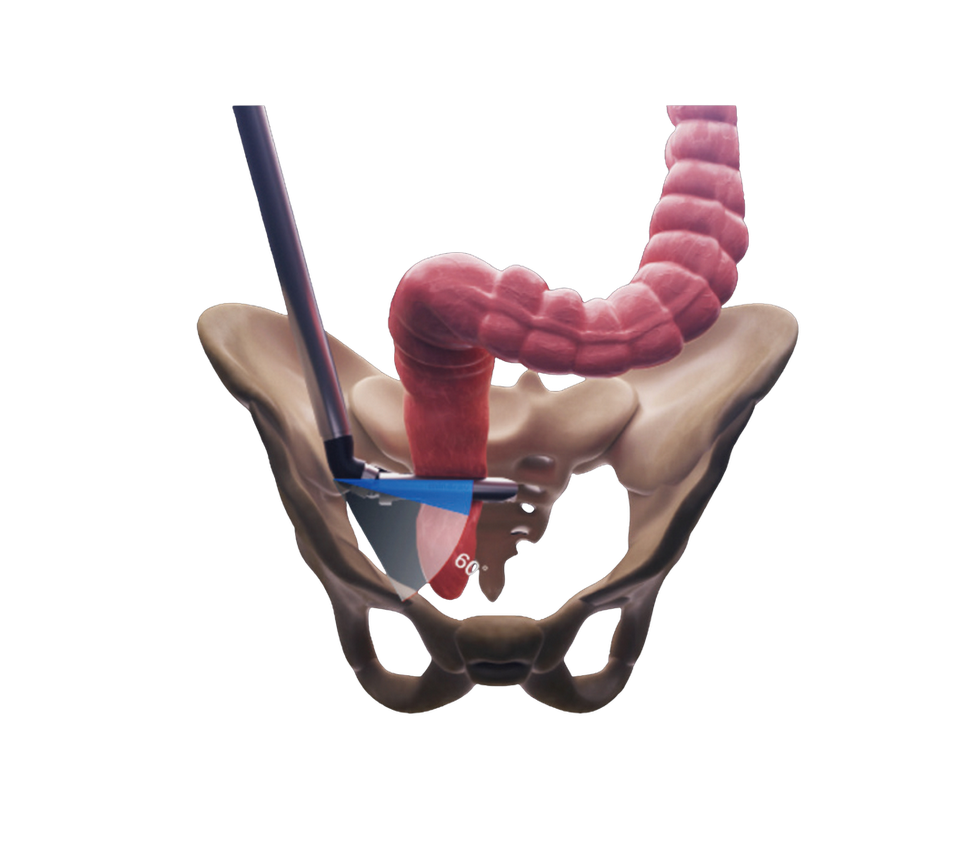 Grapadora lineal cortante desechable con capacidad de 12 disparos, eje de 340 mm y línea de grapado de 45 mm, incluye punta de yunque y herramienta de extracción.